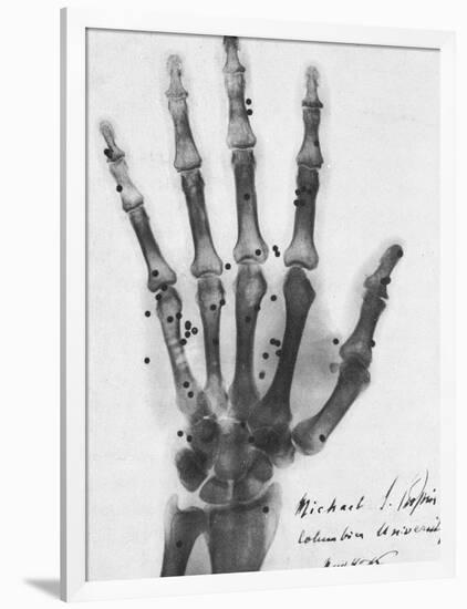 X-ray of a hand with buckshot-Science Source-Framed Giclee Print