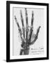 X-ray of a hand with buckshot-Science Source-Framed Giclee Print