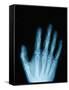 X-Ray of a Hand-Robert Llewellyn-Framed Stretched Canvas