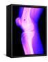 X-Ray of a Knee-null-Framed Stretched Canvas