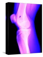 X-Ray of a Knee-null-Stretched Canvas