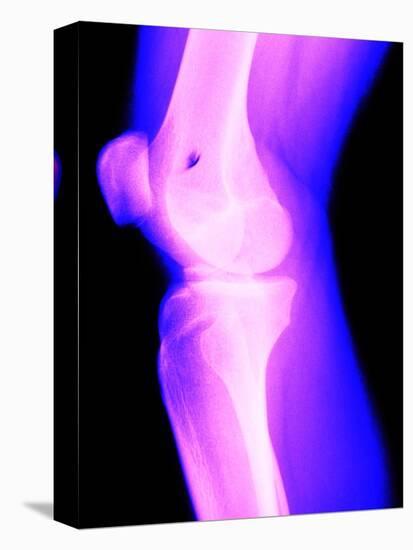 X-Ray of a Knee-null-Stretched Canvas