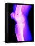 X-Ray of a Knee-null-Framed Stretched Canvas