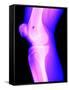 X-Ray of a Knee-null-Framed Stretched Canvas