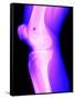 X-Ray of a Knee-null-Framed Stretched Canvas