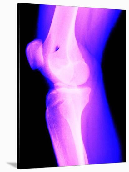 X-Ray of a Knee-null-Stretched Canvas