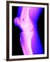 X-Ray of a Knee-null-Framed Premium Photographic Print