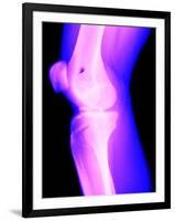 X-Ray of a Knee-null-Framed Premium Photographic Print