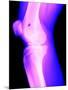 X-Ray of a Knee-null-Mounted Premium Photographic Print