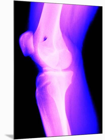 X-Ray of a Knee-null-Mounted Photographic Print