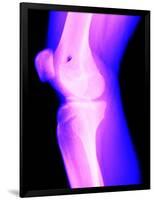 X-Ray of a Knee-null-Framed Photographic Print