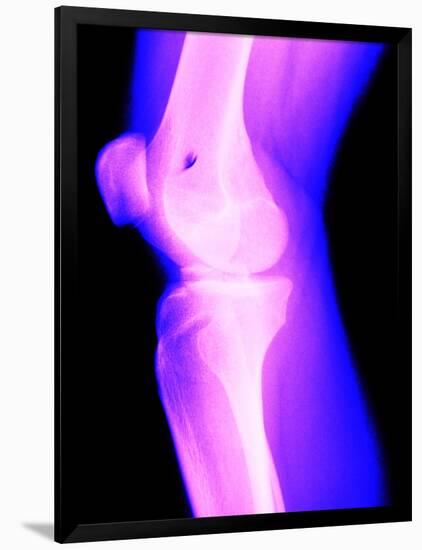 X-Ray of a Knee-null-Framed Photographic Print