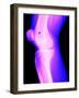 X-Ray of a Knee-null-Framed Photographic Print