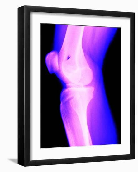 X-Ray of a Knee-null-Framed Photographic Print