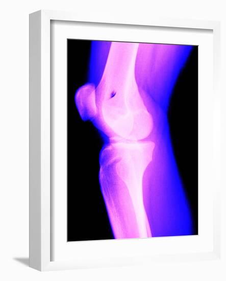 X-Ray of a Knee-null-Framed Photographic Print