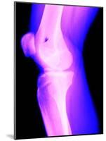 X-Ray of a Knee-null-Mounted Photographic Print