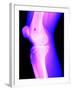 X-Ray of a Knee-null-Framed Photographic Print