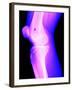 X-Ray of a Knee-null-Framed Photographic Print