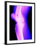 X-Ray of a Knee-null-Framed Photographic Print