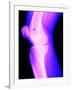 X-Ray of a Knee-null-Framed Photographic Print