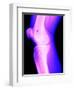 X-Ray of a Knee-null-Framed Photographic Print