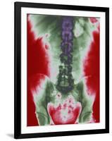 X-ray of a Torso-null-Framed Photographic Print