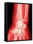 X-ray of a Wrist-null-Framed Stretched Canvas