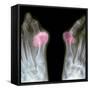 X-ray of Bunions on the Toes-Mike Devlin-Framed Stretched Canvas