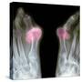 X-ray of Bunions on the Toes-Mike Devlin-Stretched Canvas