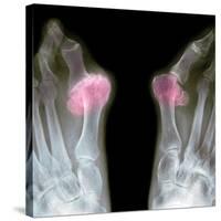 X-ray of Bunions on the Toes-Mike Devlin-Stretched Canvas