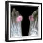 X-ray of Bunions on the Toes-Mike Devlin-Framed Premium Photographic Print