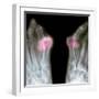 X-ray of Bunions on the Toes-Mike Devlin-Framed Premium Photographic Print