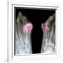 X-ray of Bunions on the Toes-Mike Devlin-Framed Photographic Print