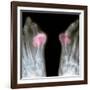 X-ray of Bunions on the Toes-Mike Devlin-Framed Photographic Print