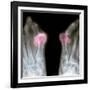 X-ray of Bunions on the Toes-Mike Devlin-Framed Photographic Print