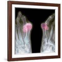 X-ray of Bunions on the Toes-Mike Devlin-Framed Photographic Print