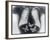 X-ray of butterflies in the stomach-Thom Lang-Framed Photographic Print