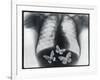 X-ray of butterflies in the stomach-Thom Lang-Framed Photographic Print