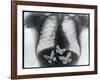 X-ray of butterflies in the stomach-Thom Lang-Framed Photographic Print