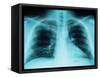 X-Ray of Dark Lungs-Robert Llewellyn-Framed Stretched Canvas