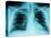 X-Ray of Dark Lungs-Robert Llewellyn-Stretched Canvas