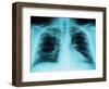 X-Ray of Dark Lungs-Robert Llewellyn-Framed Photographic Print