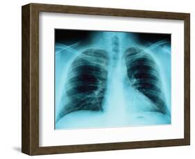 X-Ray of Dark Lungs-Robert Llewellyn-Framed Photographic Print