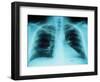 X-Ray of Dark Lungs-Robert Llewellyn-Framed Photographic Print