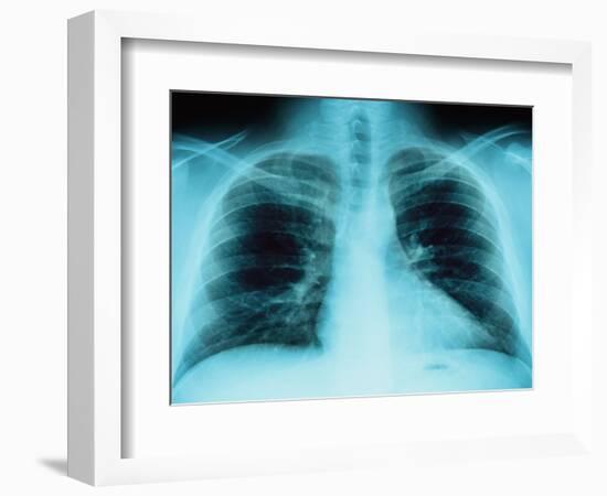 X-Ray of Dark Lungs-Robert Llewellyn-Framed Photographic Print