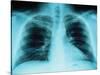 X-Ray of Dark Lungs-Robert Llewellyn-Stretched Canvas