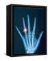 X-ray of hand with diamond ring-Thom Lang-Framed Stretched Canvas
