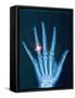 X-ray of hand with diamond ring-Thom Lang-Framed Stretched Canvas