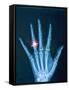 X-ray of hand with diamond ring-Thom Lang-Framed Stretched Canvas