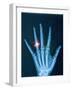 X-ray of hand with diamond ring-Thom Lang-Framed Photographic Print